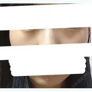 15日目の経過画像（1枚目）