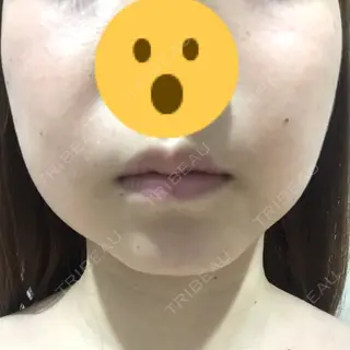 24日目の経過画像（2枚目）