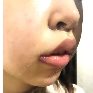 3日目の経過画像（3枚目）
