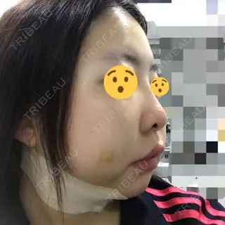 3日目の経過画像（3枚目）