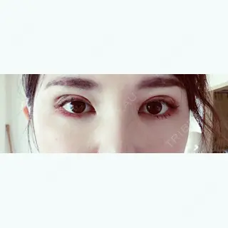 13日目の経過画像（1枚目）
