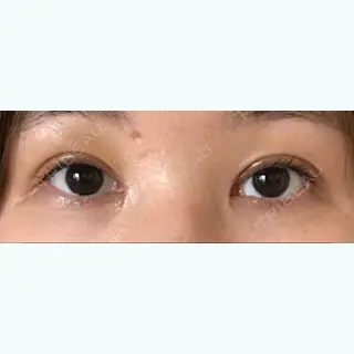 9日目の経過画像（1枚目）