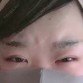 2日目の経過画像（2枚目）