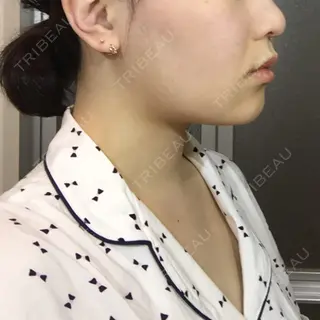 29日目の経過画像（2枚目）