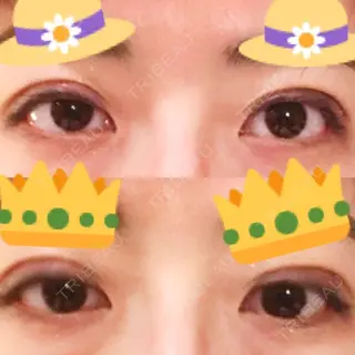 4日目の経過画像（1枚目）