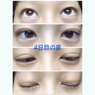 4日目の経過画像（1枚目）