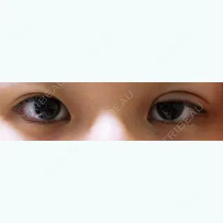 1日目の経過画像（1枚目）