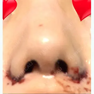 0日目の経過画像（2枚目）