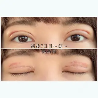 7日目の経過画像（1枚目）