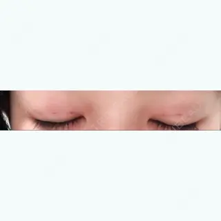 1日目の経過画像（2枚目）