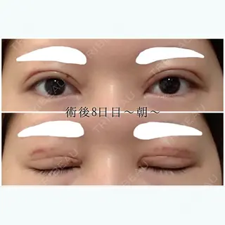 8日目の経過画像（1枚目）