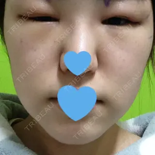 2日目の経過画像（1枚目）