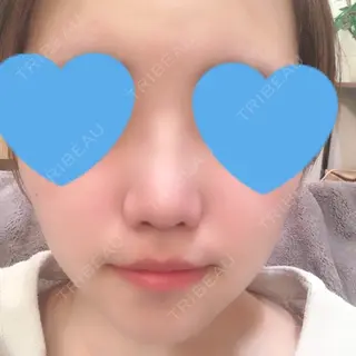 17日目の経過画像（1枚目）