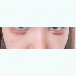 10日目の経過画像（1枚目）