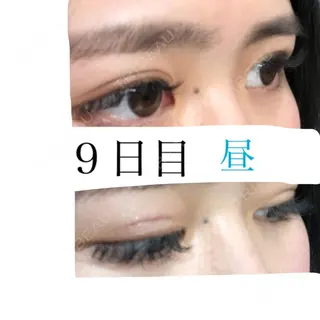 8日目の経過画像（3枚目）