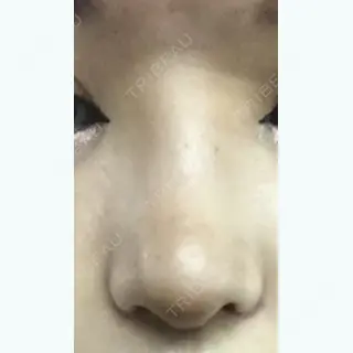 12日目の経過画像（1枚目）