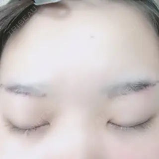 7日目の経過画像（2枚目）
