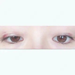 11日目の経過画像（2枚目）