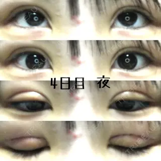 4日目の経過画像（3枚目）