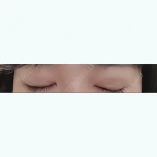 4日目の経過画像（2枚目）