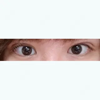 49日目の経過画像（1枚目）