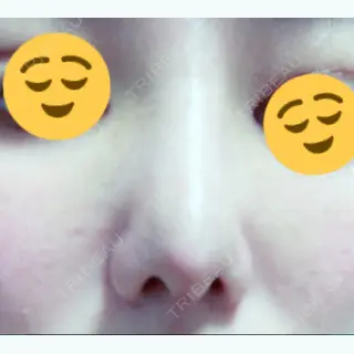 17日目の経過画像（1枚目）