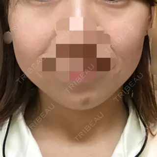 23日目の経過画像（2枚目）