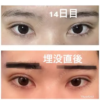 14日目の経過画像（1枚目）