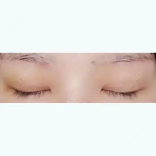 11日目の経過画像（2枚目）