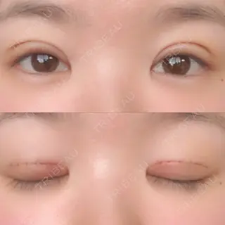 6日目の経過画像（1枚目）