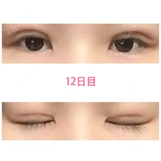 12日目の経過画像（1枚目）