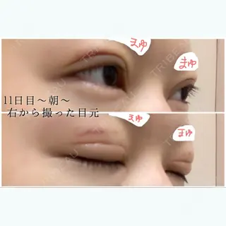 11日目の経過画像（2枚目）
