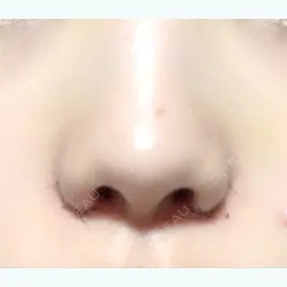 5日目の経過画像（3枚目）