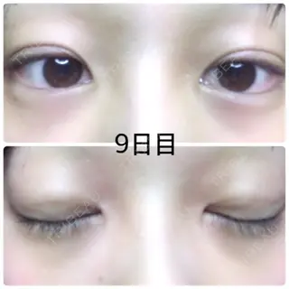9日目の経過画像（1枚目）