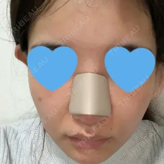 2日目の経過画像（1枚目）