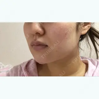 2日目の経過画像（2枚目）