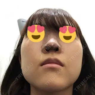 5日目の経過画像（3枚目）