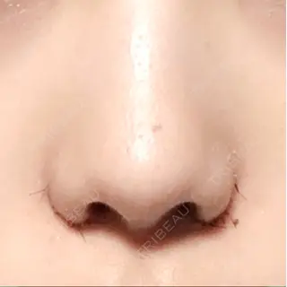 6日目の経過画像（3枚目）