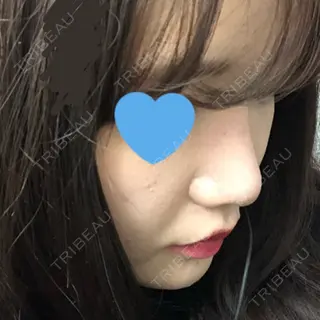 22日目の経過画像（2枚目）