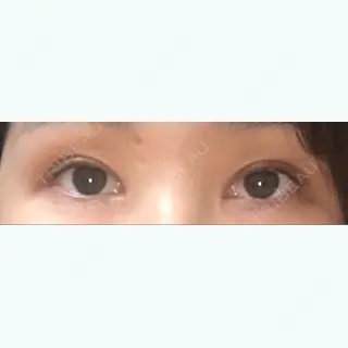 15日目の経過画像（1枚目）