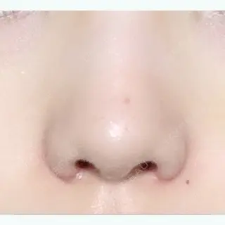 7日目の経過画像（2枚目）