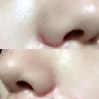 7日目の経過画像（3枚目）