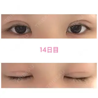 14日目の経過画像（1枚目）
