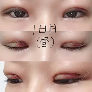 1日目の経過画像（1枚目）