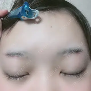 11日目の経過画像（2枚目）
