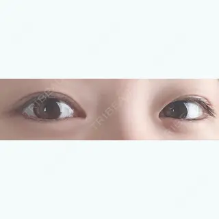 16日目の経過画像（1枚目）