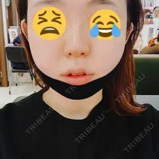 0日目の経過画像（1枚目）