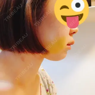 6日目の経過画像（2枚目）