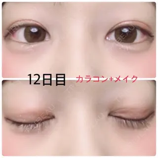 12日目の経過画像（1枚目）
