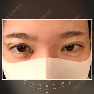 2日目の経過画像（1枚目）